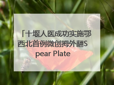 十堰人医成功实施鄂西北首例微创拇外翻Spear Plate髓内板矫形术
